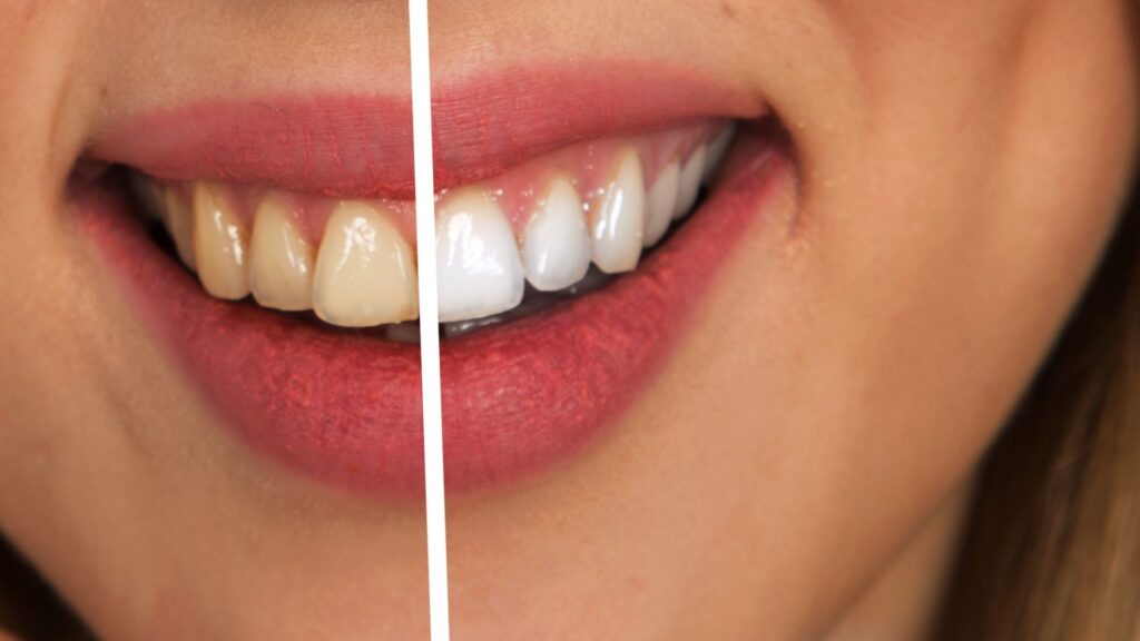 Descubra onde fazer clareamento dental em São José do Rio Preto e transforme seu sorriso com a Essence Odontologia.